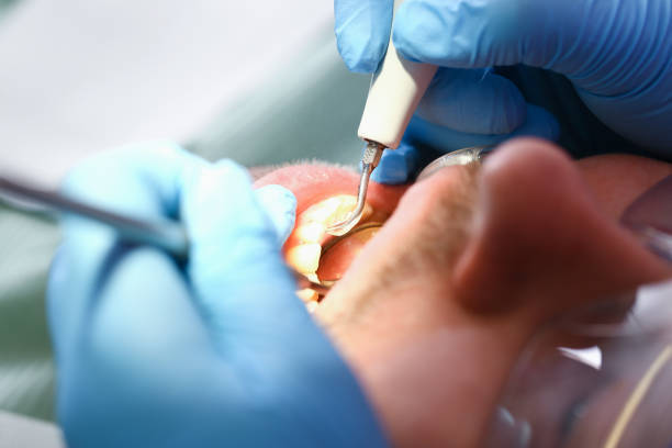 Best Emergency Dental Care for Abscessed Tooth in New London, TX