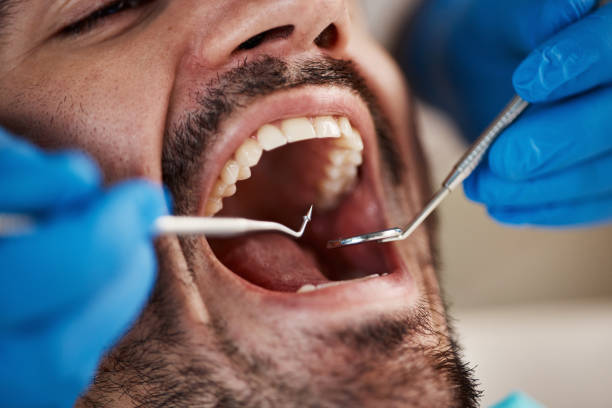 Best Emergency Dentist for Lost Fillings or Crowns in New London, TX